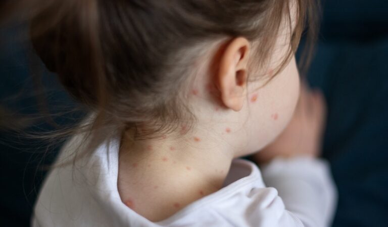 child with measles